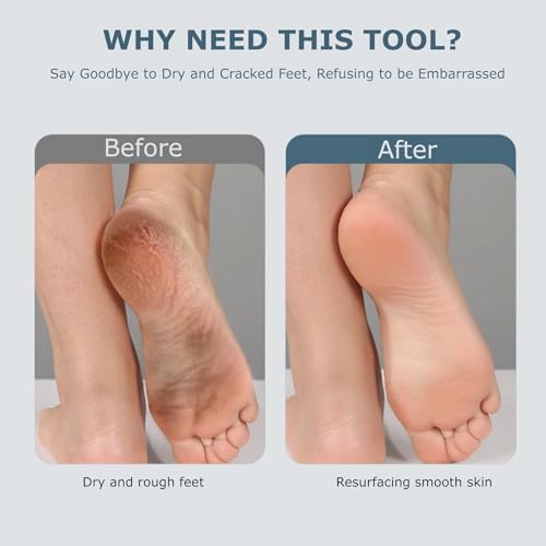 Electric Foot Callues Remover - FSA&HSA Eligible, Portable Electric Foot Files with 3 Heads, Rechargeable Feet File for Foot Care, Waterproof Deadskin Remover, Pedicure Tool for Dry and Crack Feet