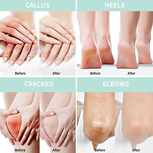 Urea Cream 20 Percent For Feet Plus 2% Salicylic Acid 150g || Foot Cream and Hand Cream Maximum Strength with Hyaluronic Acid, Tea Tree, and Aloe Vera for Deep Moisturizes